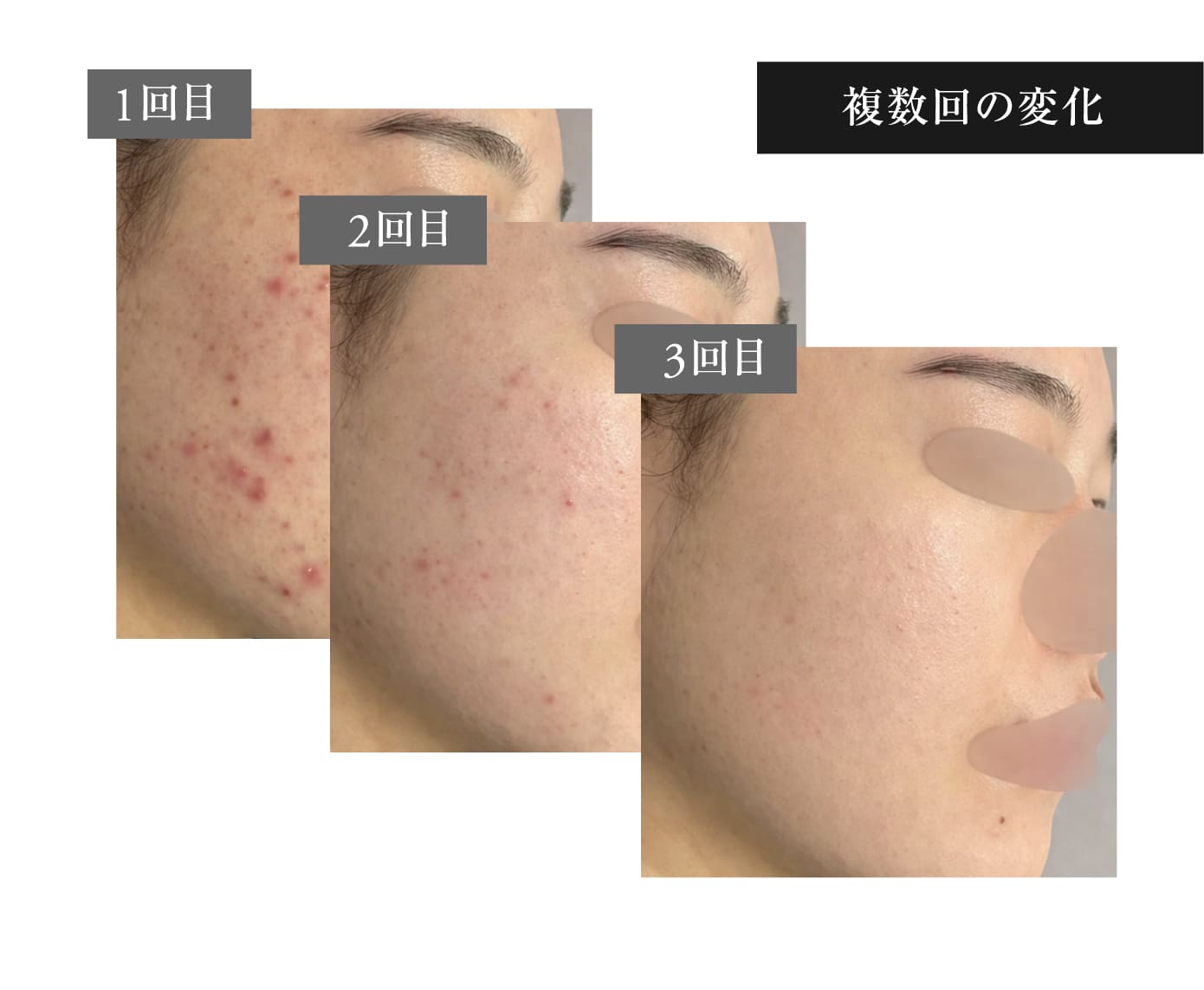 施術症例 4